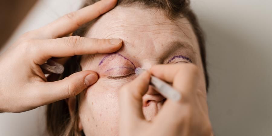 diagnostico ptosis palpebral