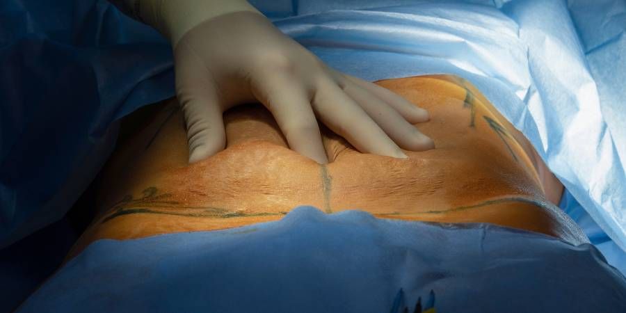 quitar flacidez con abdominoplastia